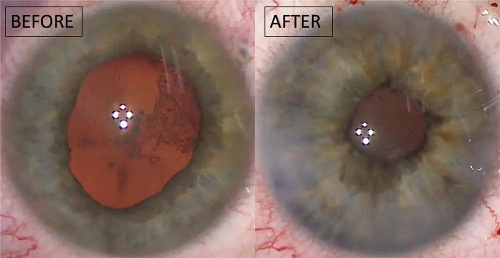 Iris Repair or Replacement