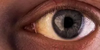 Why are my eyes yellow? – Opthalmologist, Gold Coast, image size:350x175