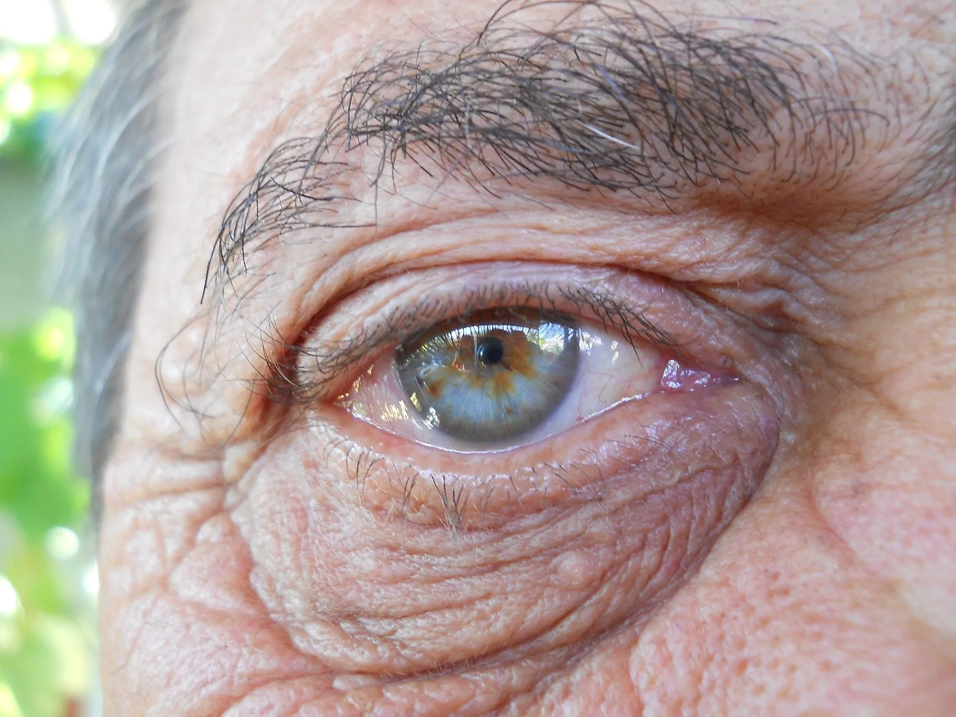 Why are my eyes yellow? – Opthalmologist, Gold Coast