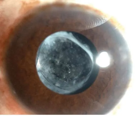 Pco eye discount